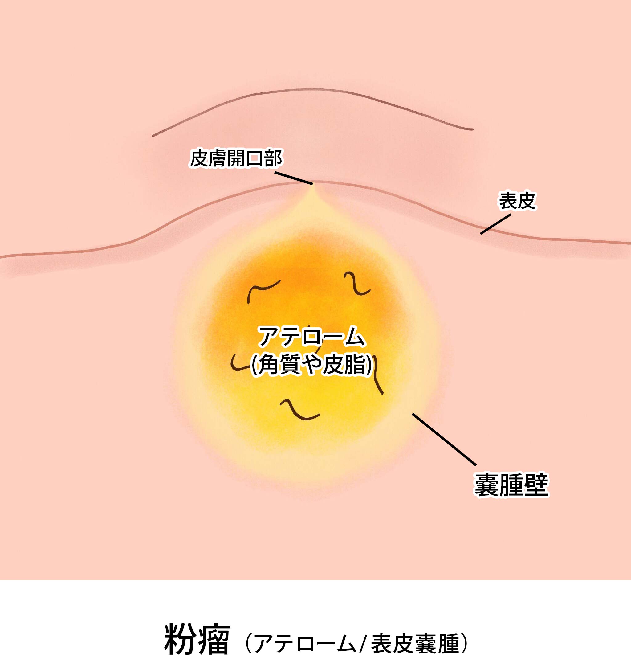 粉瘤