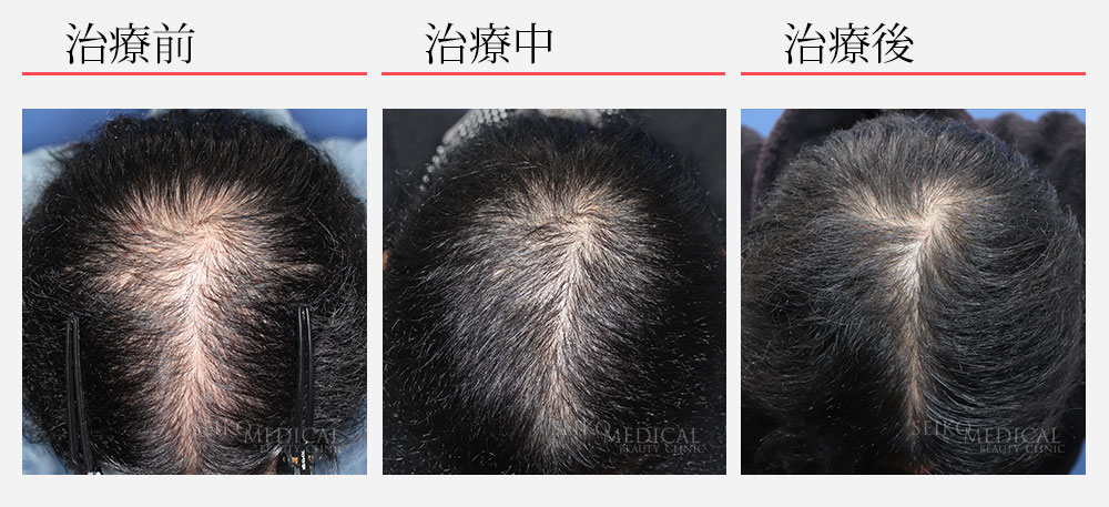 毛髪再生療法５回 ヘアリバイバル６ヶ月症例写真
