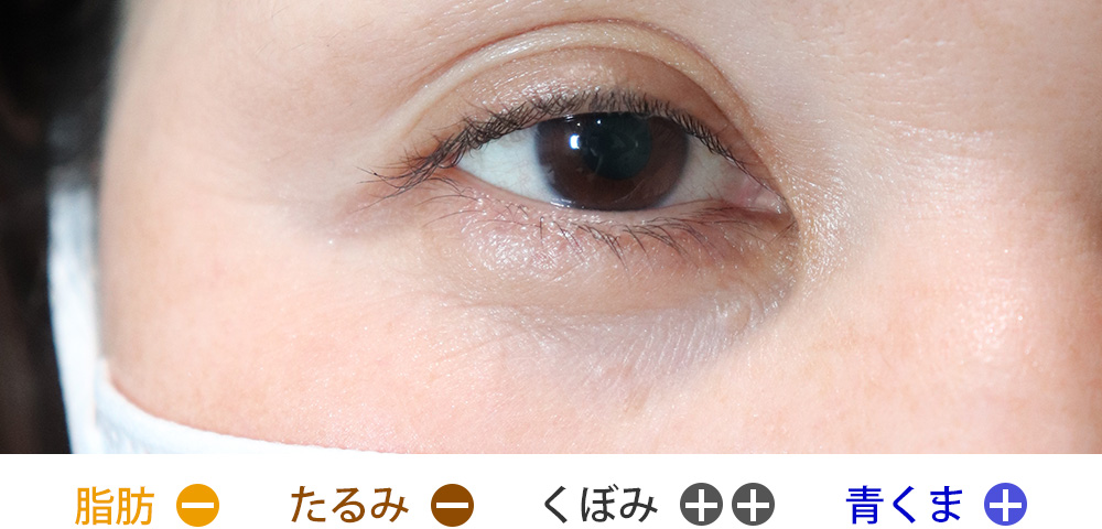 脂肪の突出がなく、くぼみが目立つタイプ