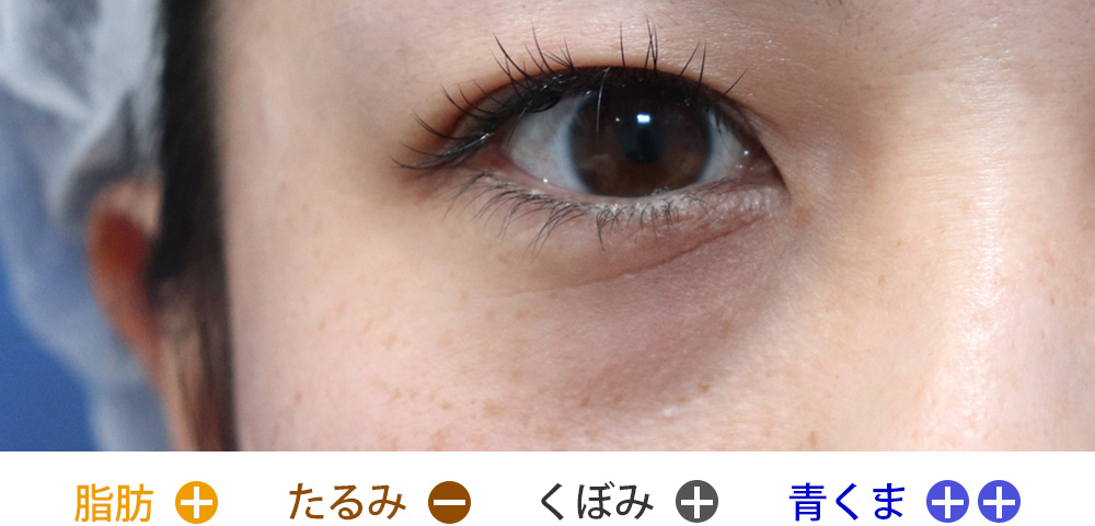 脂肪の突出と青クマがあるが、皮膚のたるみが無いタイプ