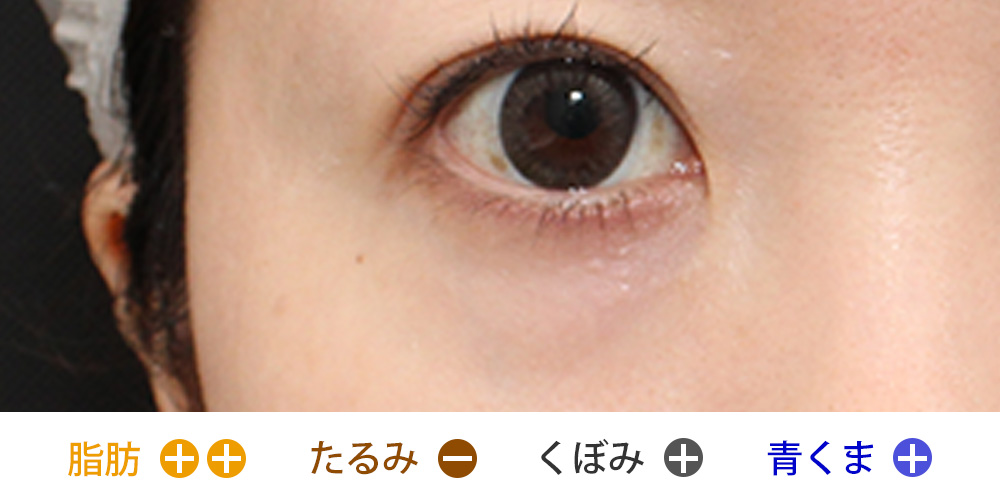 脂肪の突出があり、軽度のくぼみと青クマがあるタイプ