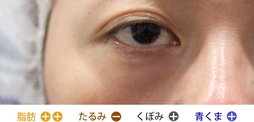 脂肪の突出があり、軽度のくぼみと青クマがあるタイプ