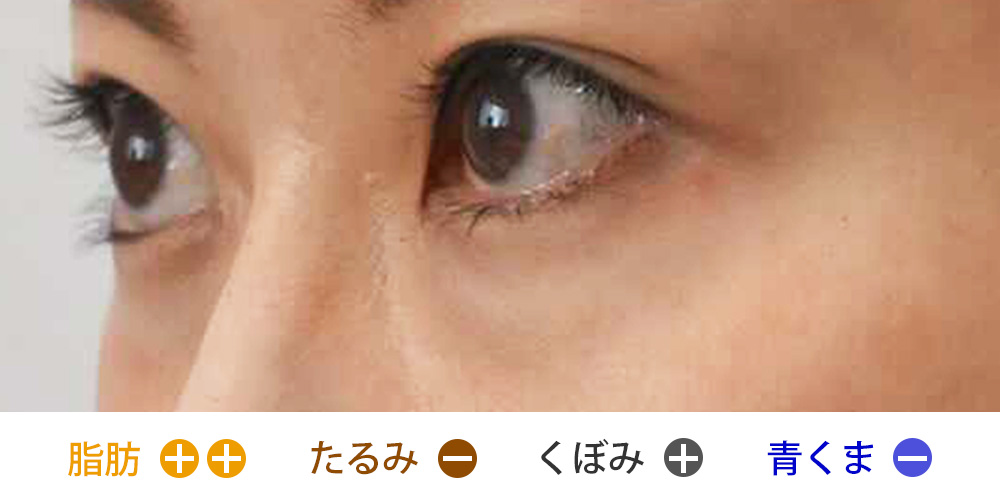 脂肪の突出とくぼみがあり、青クマが目立たないタイプ