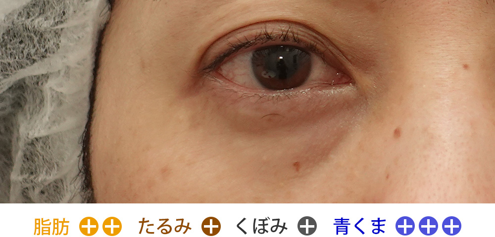 脂肪の突出・くぼみ・強い青クマがあるタイプ