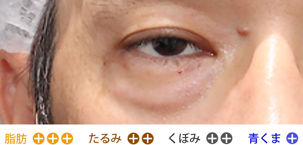 脂肪の膨らみ・皮膚のたるみ・くぼみが強いタイプ