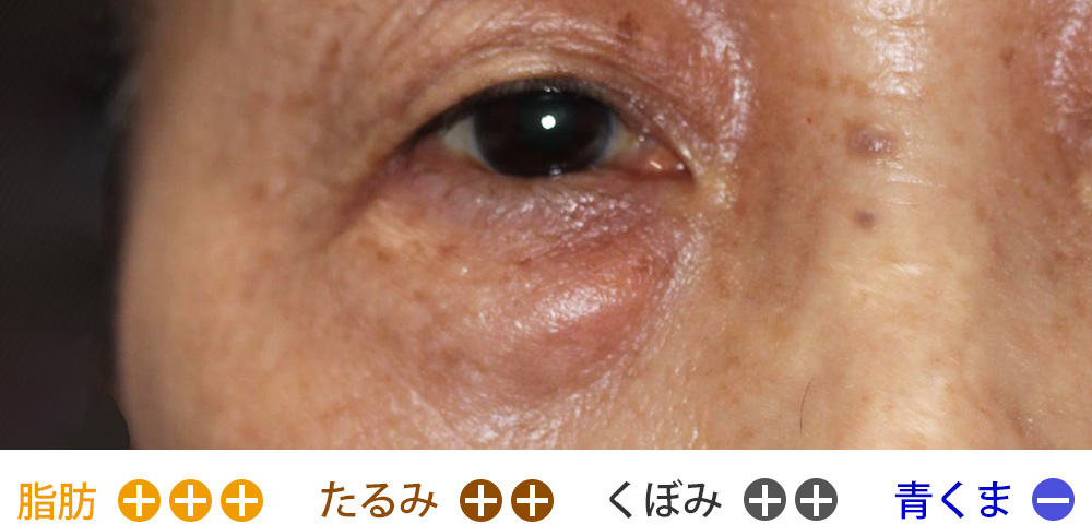 脂肪の膨らみ・皮膚のたるみ・くぼみが強く、皮膚が薄いタイプ