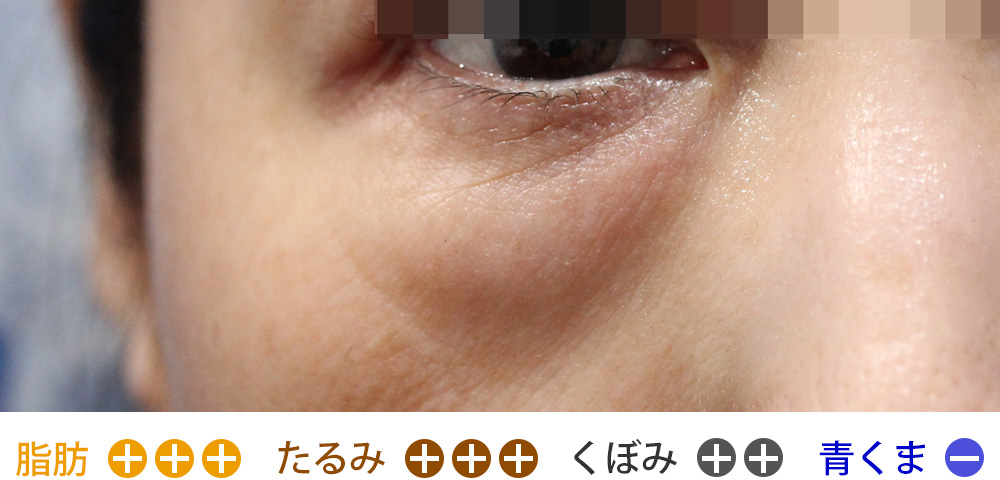 脂肪の突出・たるみが非常に強く、くぼみもしっかりあるタイプ