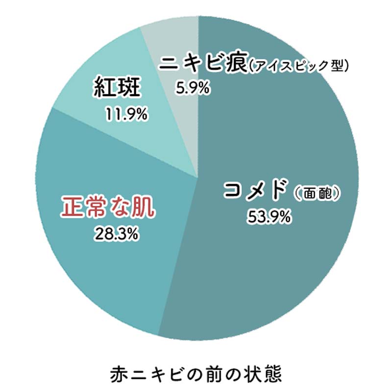 赤ニキビは何から出来るの？