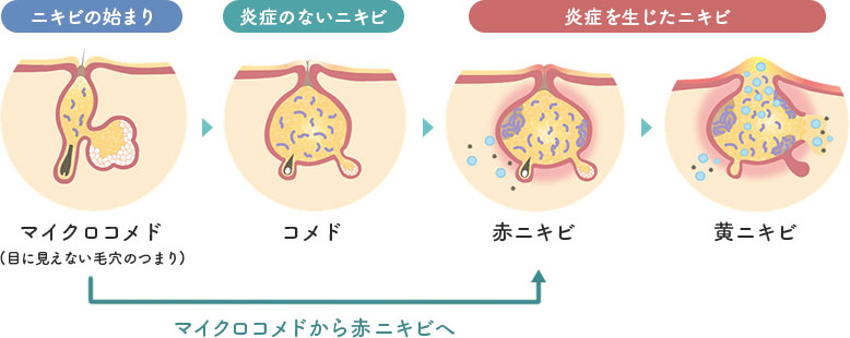 マイクロコメドから赤ニキビへ