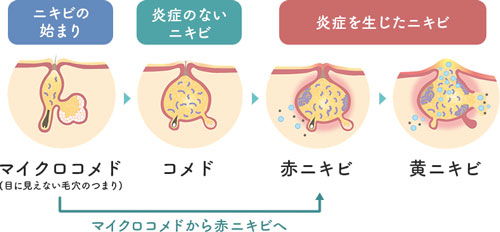 マイクロコメドから赤ニキビへ