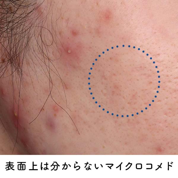 表面上は分からないマイクロコメド