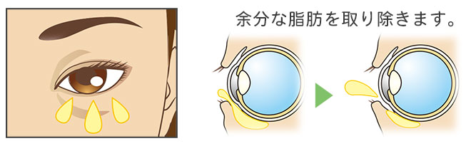 余分な脂肪を取り除きます。