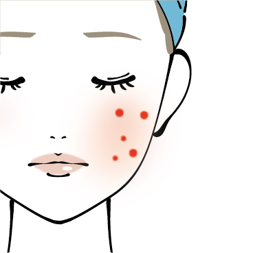 赤み（PIE【post-inflammatory erythema】　炎症後紅斑）