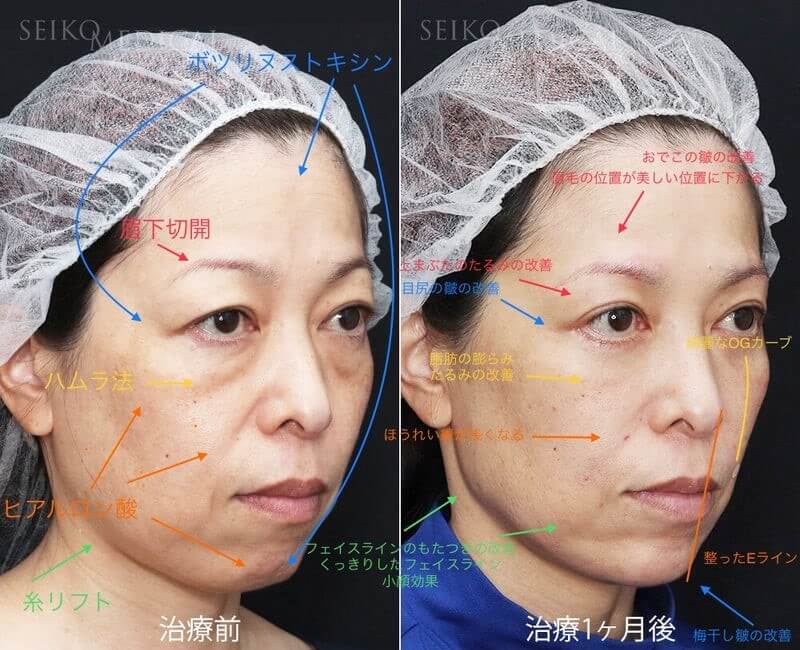 切開と注入の複合治療で、お顔の自然な若返りを目指す