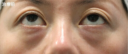 下眼瞼の膨らみが気になる方に対する脂肪除去症例
