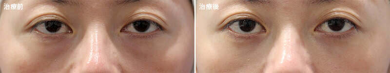 下眼瞼脂肪除去の正面写真