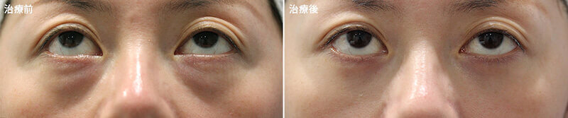 下眼瞼脂肪除去の上方視写真