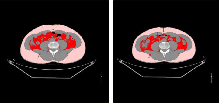 【エムスカルプト結果編】筋肉は2割増加し、皮下脂肪は2割減りました!