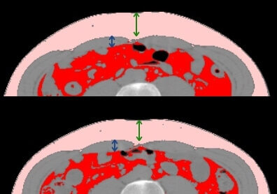 【エムスカルプト結果編】筋肉は2割増加し、皮下脂肪は2割減りました!