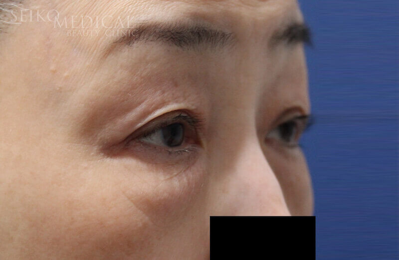 下眼瞼治療　治療前