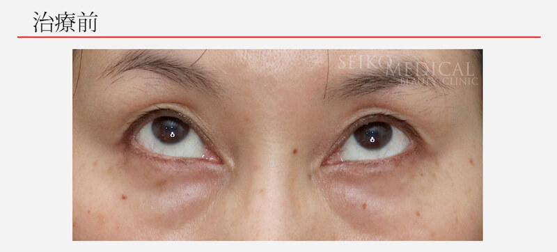 下眼瞼の脱脂 症例写真2