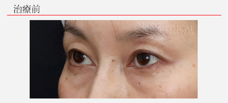 下眼瞼の脱脂 症例写真3
