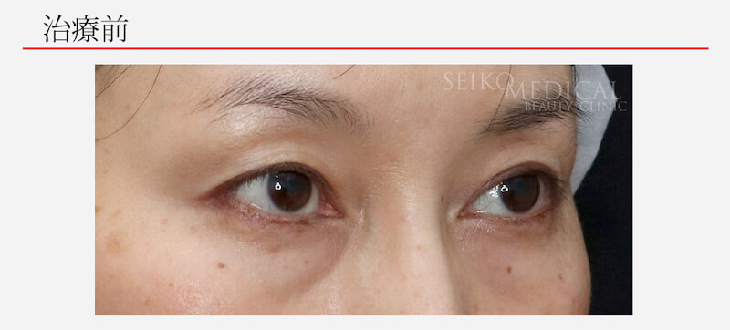 下眼瞼の脱脂 症例写真4