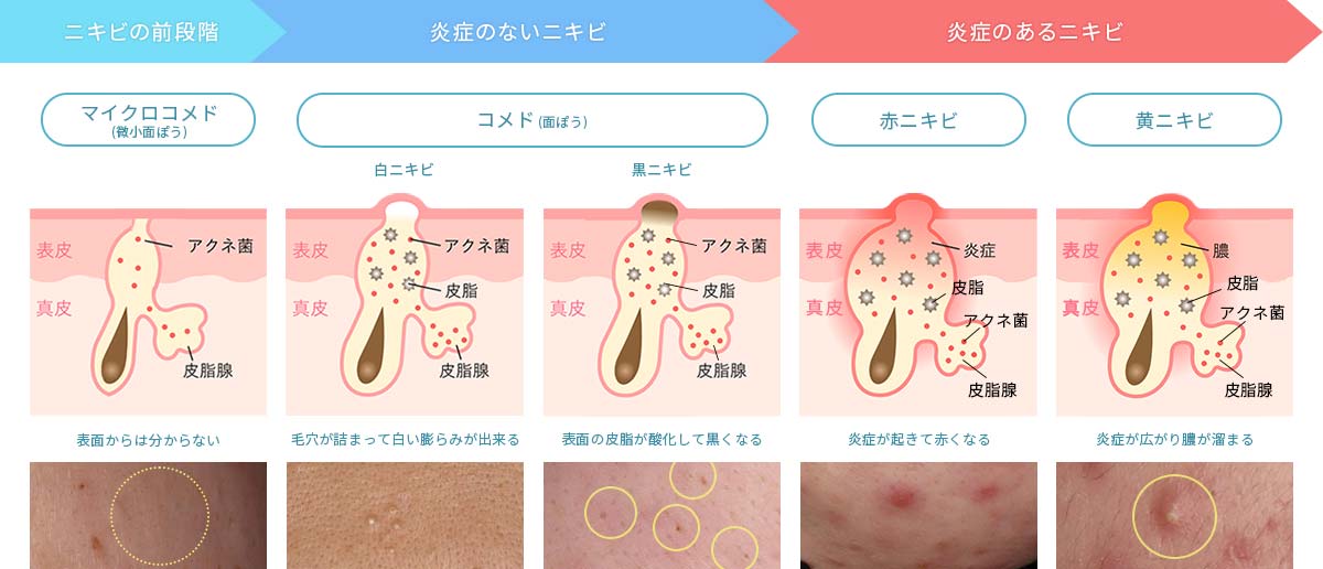 ニキビの状態
