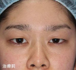 眼瞼下垂修正法