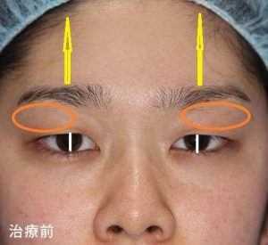 眼瞼下垂修正法