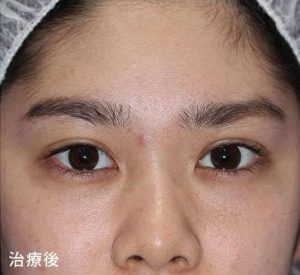 眼瞼下垂修正法