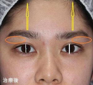 眼瞼下垂修正法