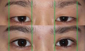 眼瞼下垂修正法