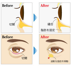 ハムラ法 裏ハムラ法