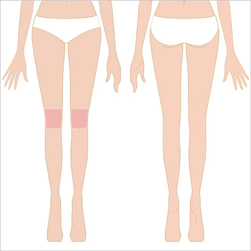 女性脱毛　両ひざ周り