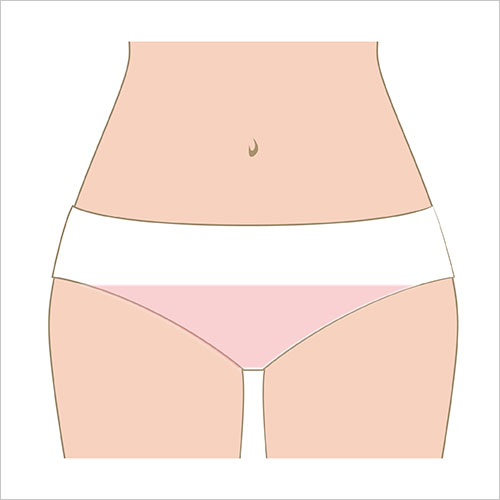 女性脱毛　Iライン（上部）