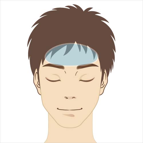 男性脱毛　額