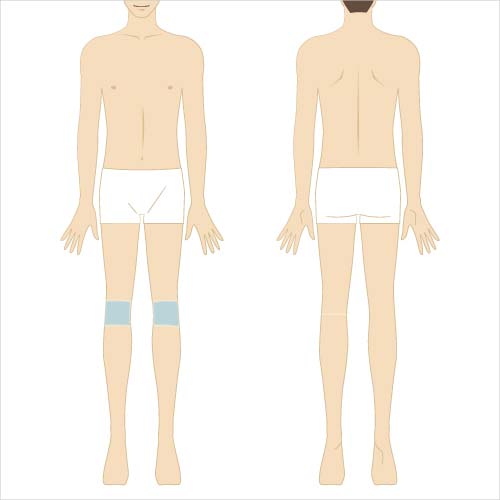 男性脱毛　両ひざ周り
