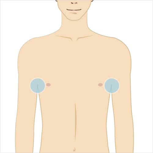 男性脱毛　ワキ