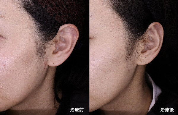 立ち耳修正
