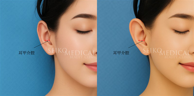 耳甲介腔が広く、耳の幅が広い