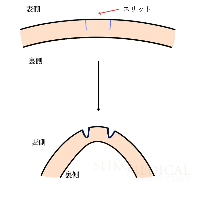 埋没法のスリット入れ