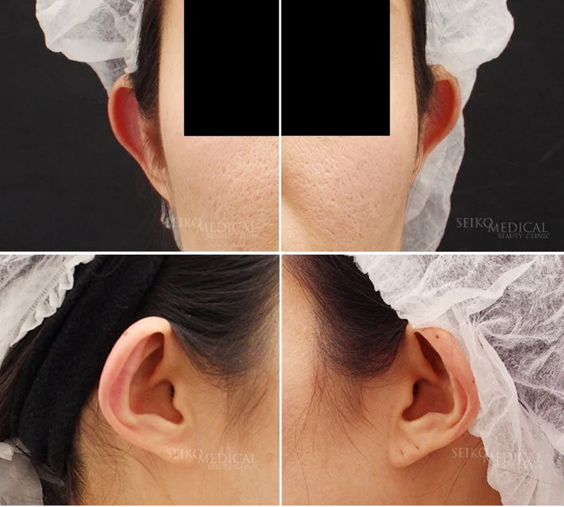 他院で一般的な切開法を行なっても立ち耳が治らなかった症例写真