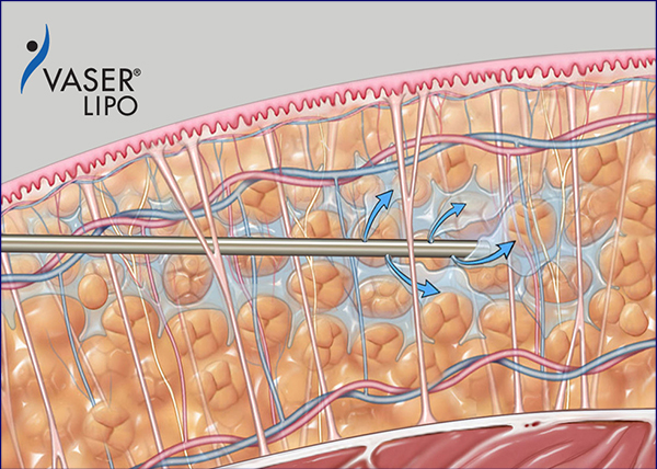 脂肪層に麻酔液を注入