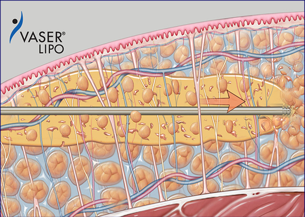 ベイザー波で脂肪を遊離