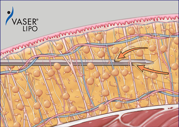 溶かした脂肪を吸引