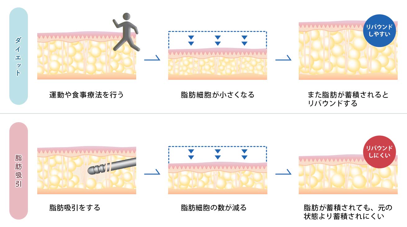 ベイザー脂肪吸引とダイエットの違い・持続性