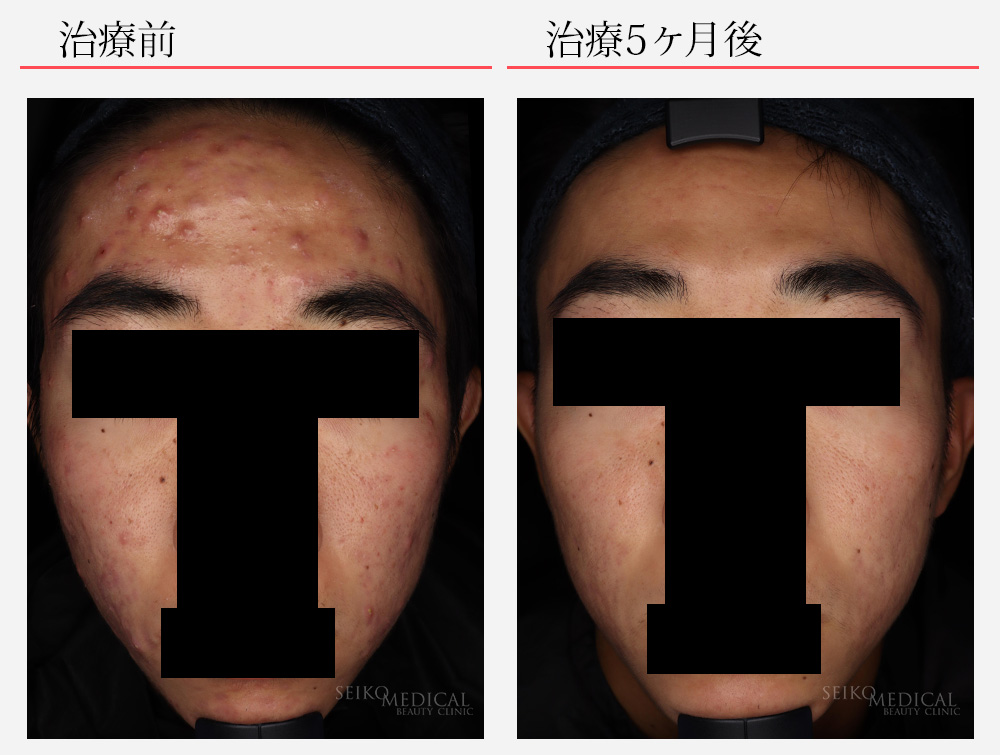 イソトレチノイン（ロアキュタン）・面ぽう圧出　症例写真
