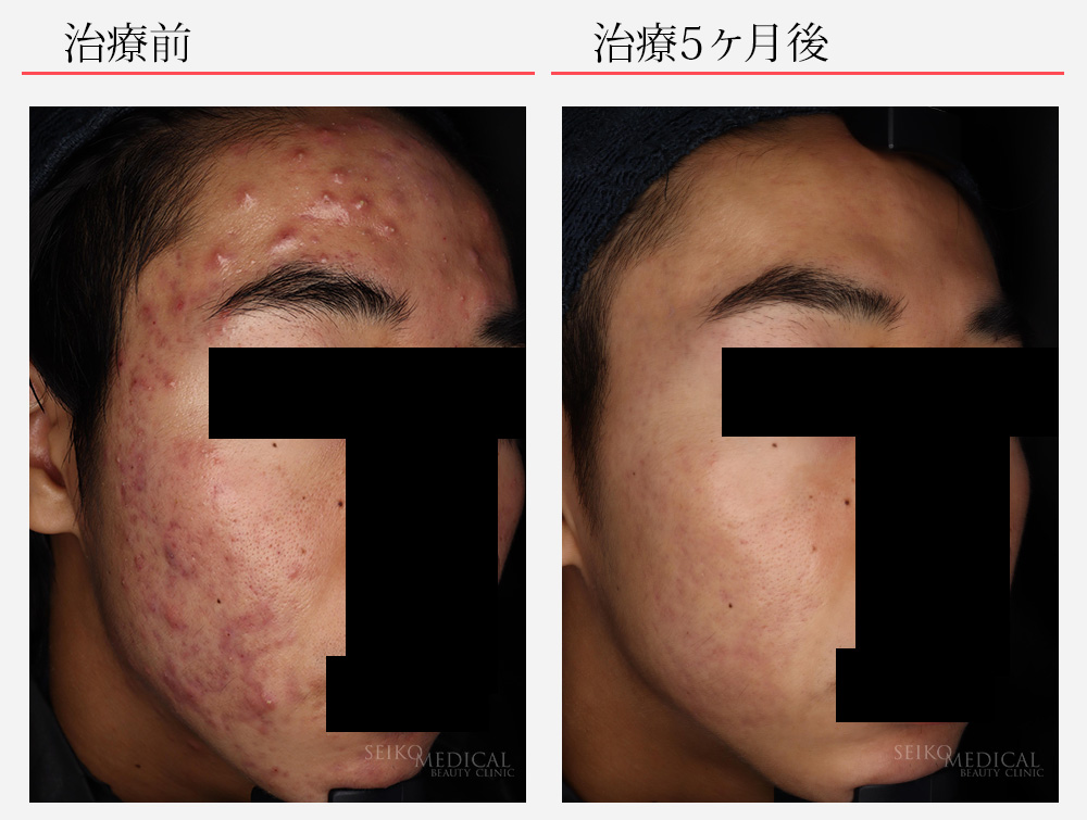 イソトレチノイン（ロアキュタン）・面ぽう圧出　症例写真