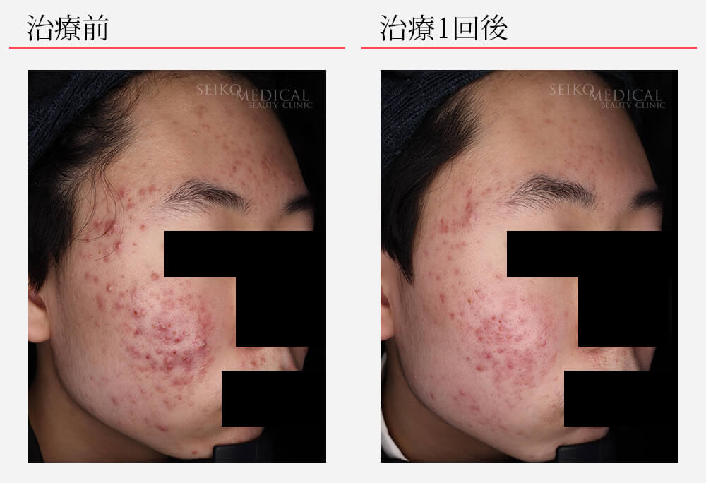 アグネス症例 10代男性 全顔治療